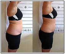 Chiropractic Tempe AZ Lipo Laser Before and After